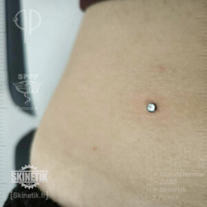Implant microdermal